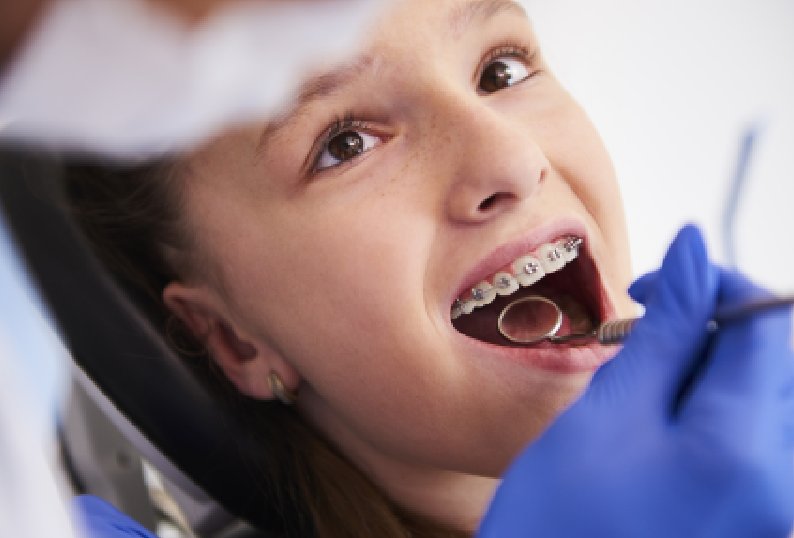 Correct Age To Get Braces Or Invisalign Done