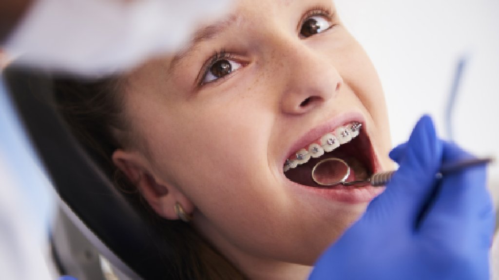 Conventional vs Self Locking braces – What to choose?