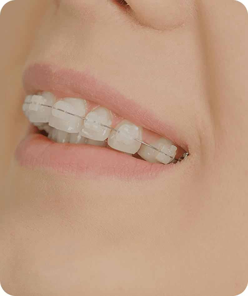 Dr. Ravneet Kaur, renowned orthodontist in Gurgaon, specializes in ceramic braces, offering discreet and effective teeth alignment solutions.